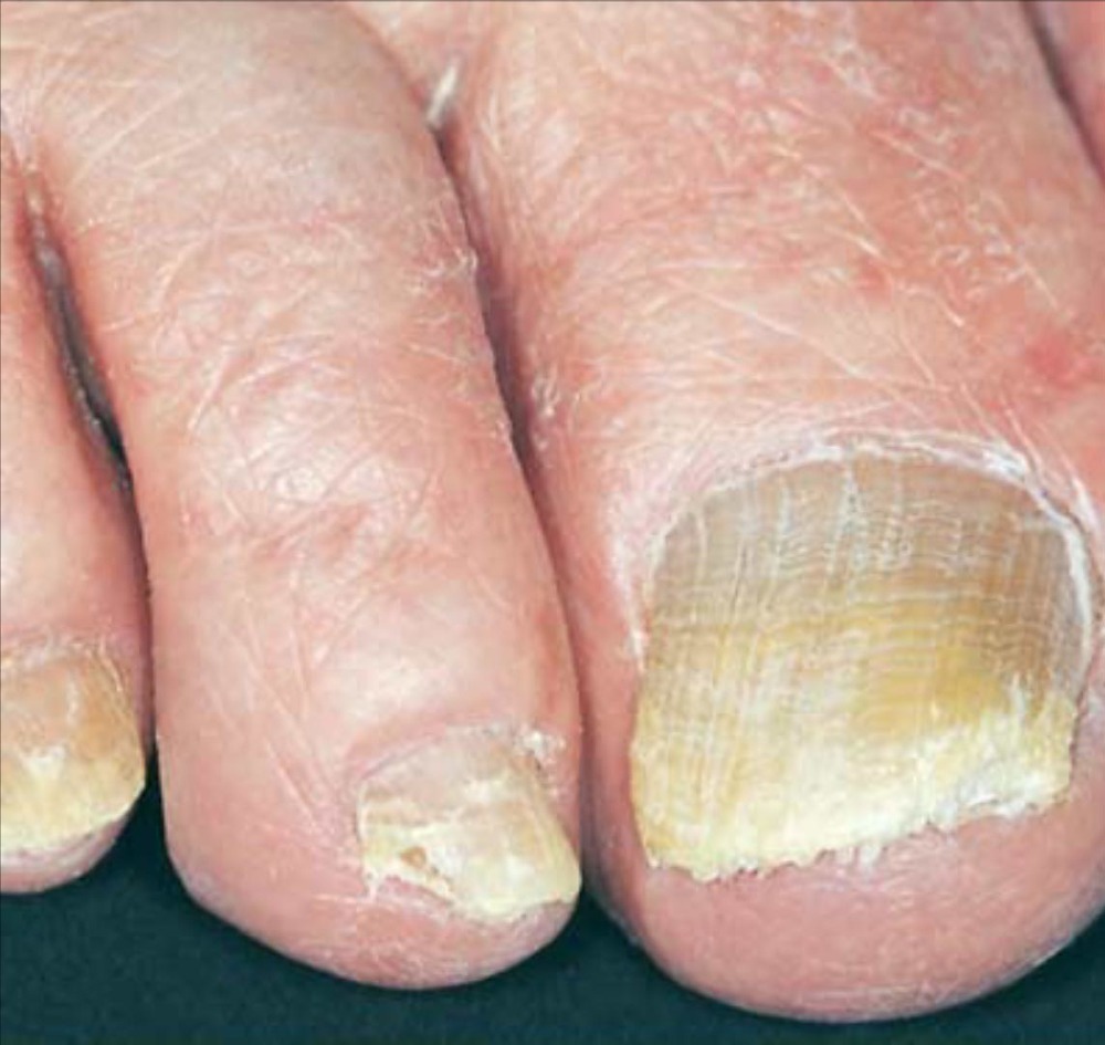 Nail fungal infections