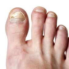 fungal nail infection feet